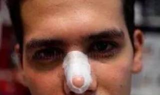 缩鼻头多少钱 整形鼻子需要多少钱